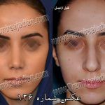 تصویر شماره 126 جراحی بینی