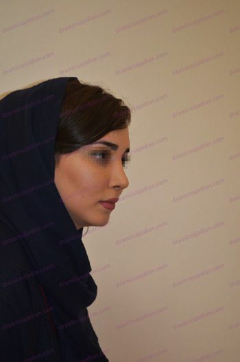 FAQS Rhinoplasty in Iran