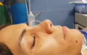 Revision Rhinoplasty And Augmentation With Dice Cartilage