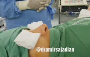 Tertiary rhinoplasty (hanging columella)