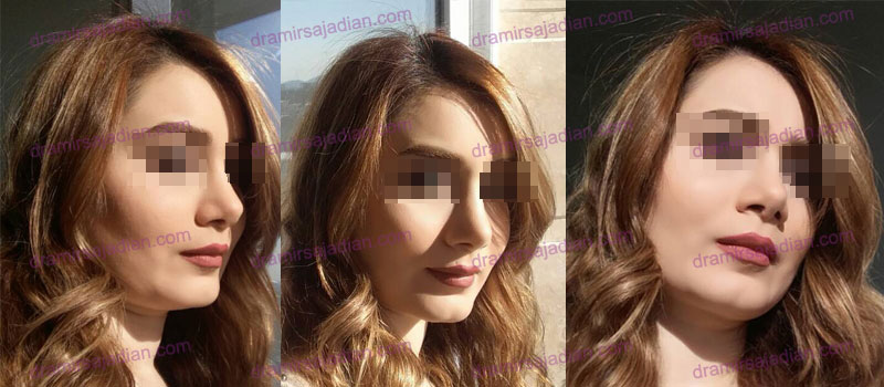 Revision Rhinoplasty