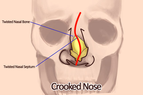 Deviated Nose - 1