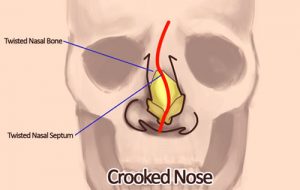 انحراف بینی - 1
