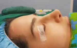 Revision Rhinoplasty in a patient from tunisia