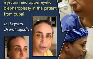 facelift patient from dubai